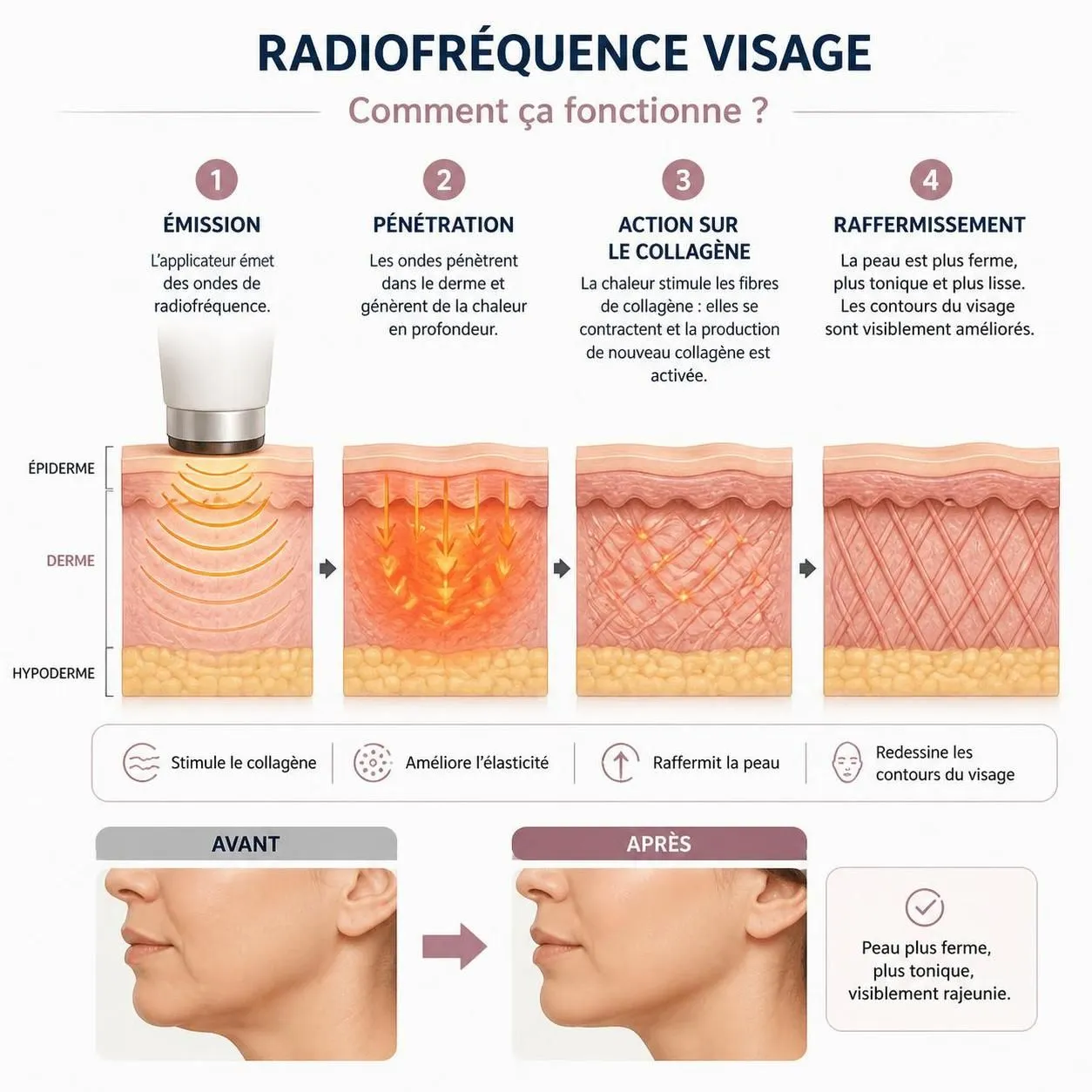 découvrez comment fonctionne la radiofréquence visage, les résultats attendus pour une peau plus ferme et éclatante, ainsi que les tarifs prévus en 2026 pour ce soin innovant et non invasif.